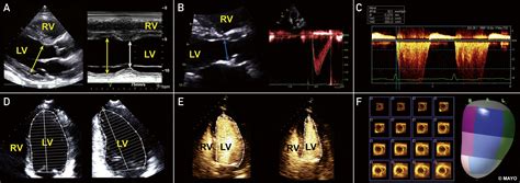 lv cardio|Echocardiographic Assessment of Left Ventricular .